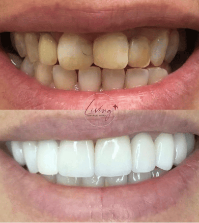 Lentes de Contato Dental