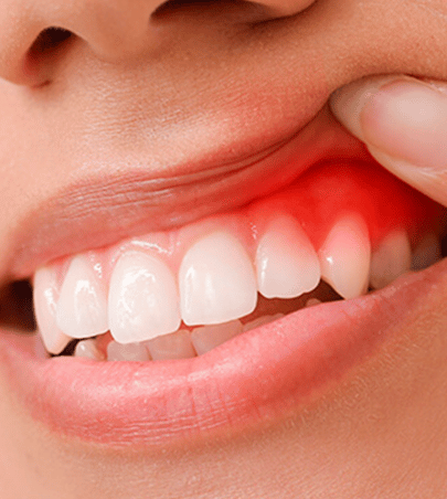 Tratamento Gengival Periodontia