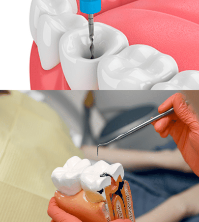 Tratamento de Canal Endodontia